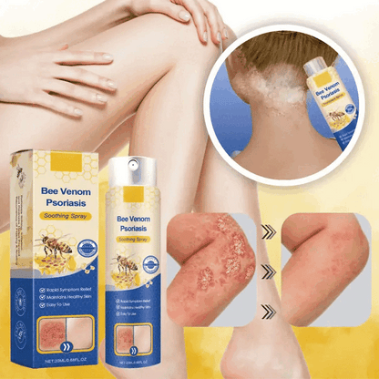 Bee Venom Spray 2x1: Alivio inmediato para piel sensible con Psoriasis.