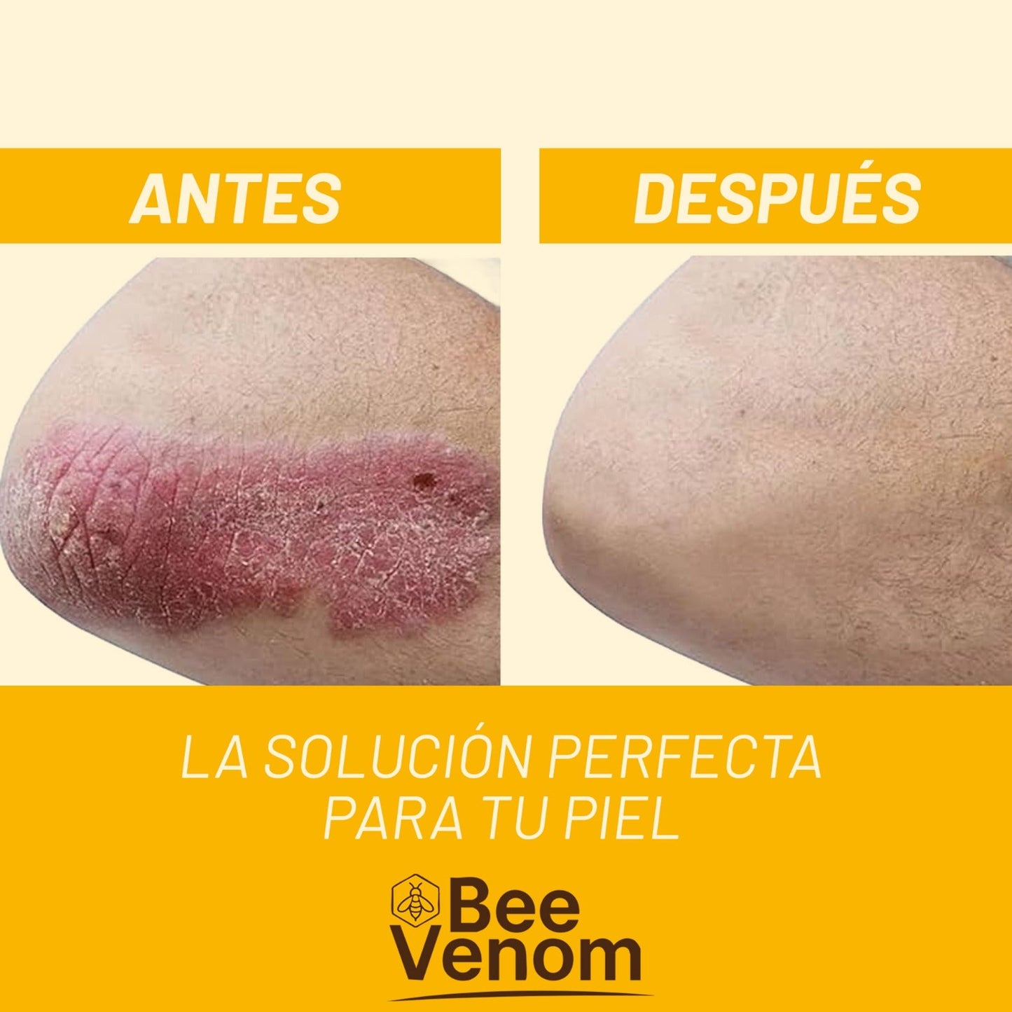 Bee Venom Spray 2x1: Alivio inmediato para piel sensible con Psoriasis.