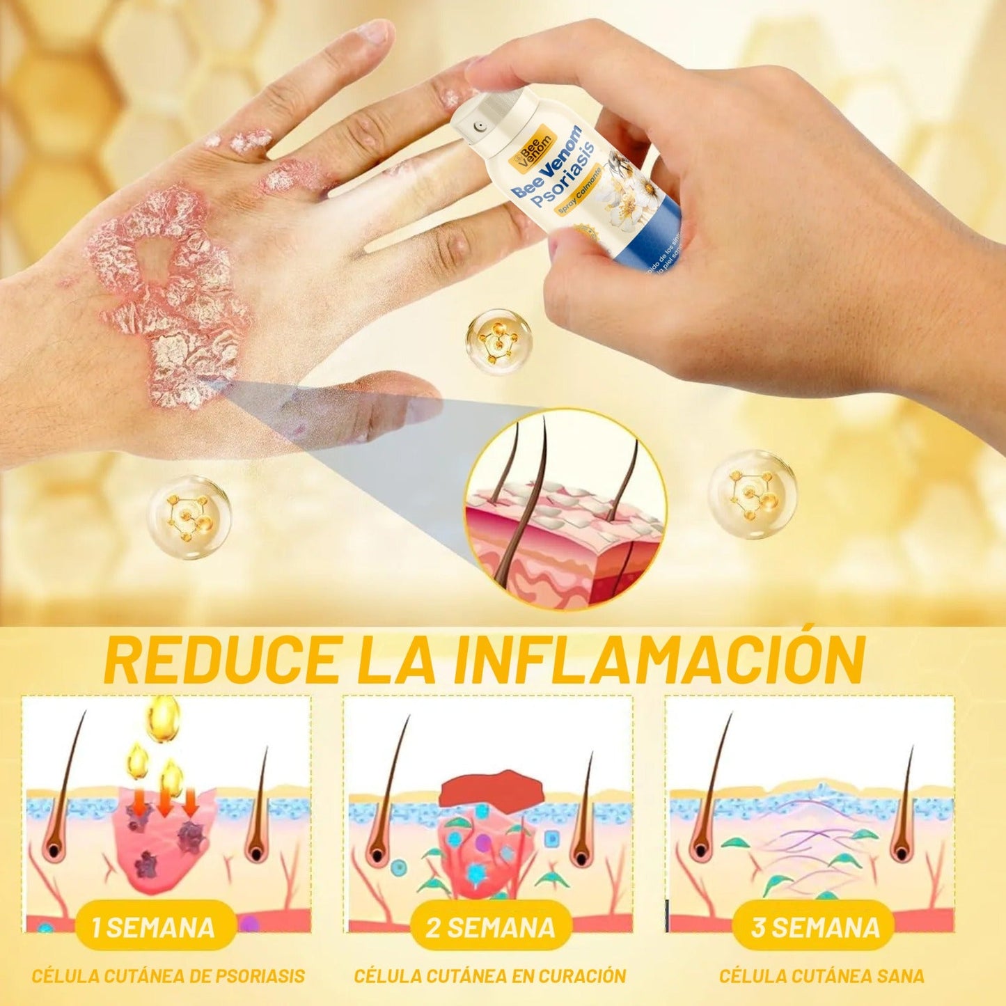 Bee Venom Spray 2x1: Alivio inmediato para piel sensible con Psoriasis.