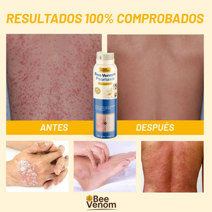 Bee Venom Spray 2x1: Alivio inmediato para piel sensible con Psoriasis.